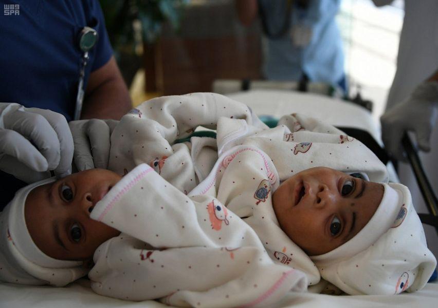 Tanzanian Conjoined Twins Arrive In Riyadh Arab News