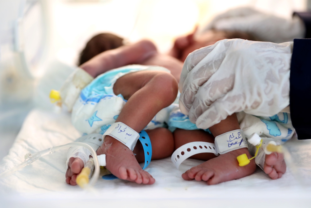 A nurse attends to newly born conjoined twins in an incubator at the child intensive care unit of Al-Sabeen hospital in Sanaa, Yemen Dec. 18, 2020. (Reuters)