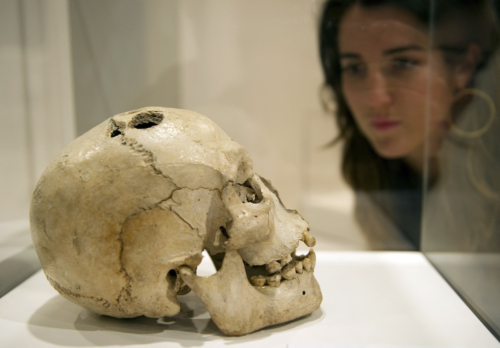 A woman looks at a bronze age skull from Jericho, dated to between 2200 and 2000 BCE, showing the ancient surgical procedure of trephination. (AFP)