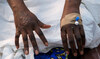 Morocco sees first mpox case in North Africa during emergency