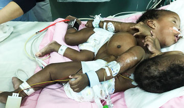 Sudanese conjoined twins to be treated on Sunday in Riyadh