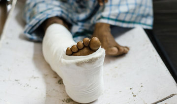 India doctors suspended after severed leg used as pillow