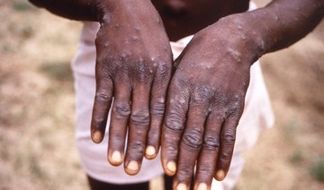 Health experts put Hajj season monkeypox concerns into perspective