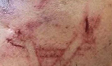 Israeli forces allegedly brand Star of David on Palestinian man’s cheek