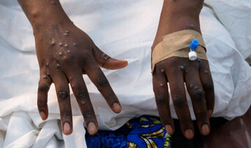 Morocco sees first mpox case in North Africa during emergency