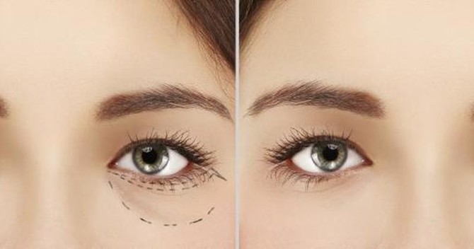 Cosmetic treatments for under-eye issues