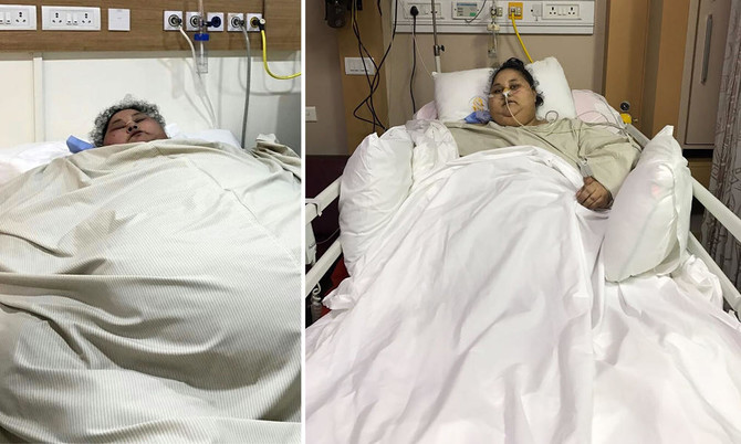 ’World’s heaviest woman’ loses 100 kg after surgery in India