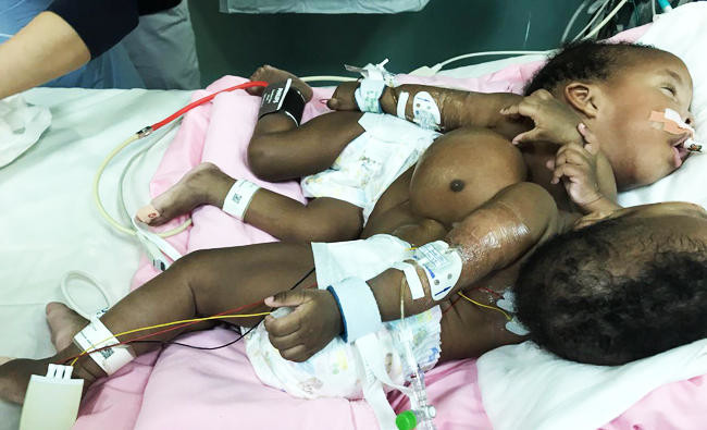 Sudanese conjoined twins to be treated on Sunday in Riyadh