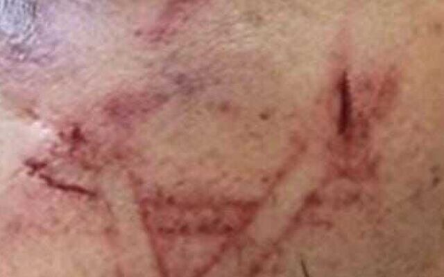 Israeli forces allegedly brand Star of David on Palestinian man’s cheek