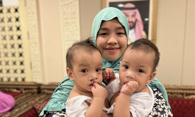 Saudi team in Manila to transport Filipino conjoined twins for surgery in Riyadh