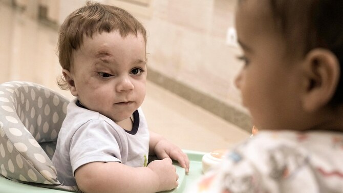 A baby evacuated from Gaza lost an eye and most of his family in the war