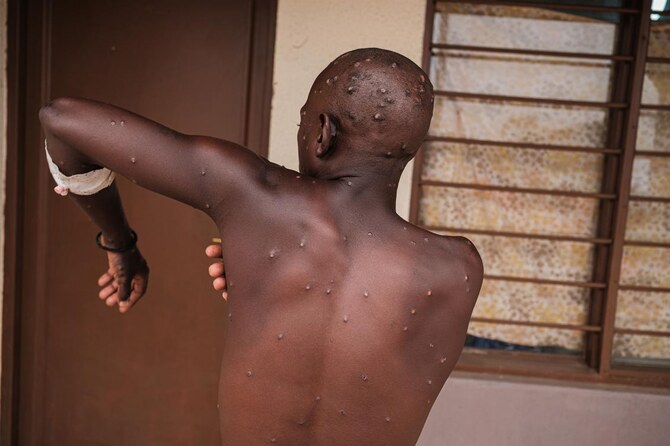 Uganda confirms two more cases of mpox