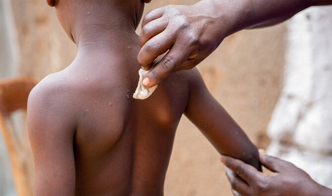 UNICEF issues emergency tender to secure mpox vaccines