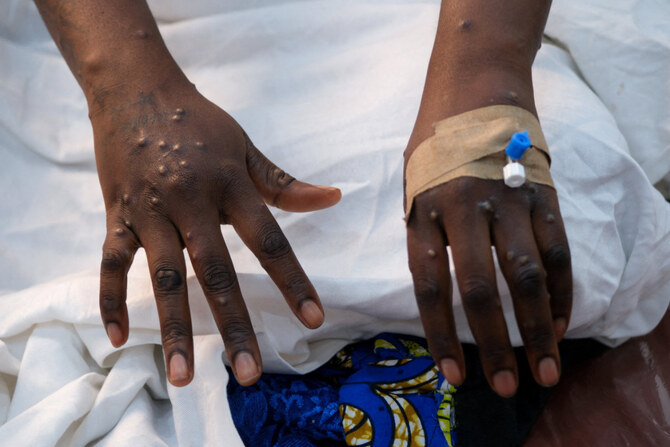 Morocco sees first mpox case in North Africa during emergency